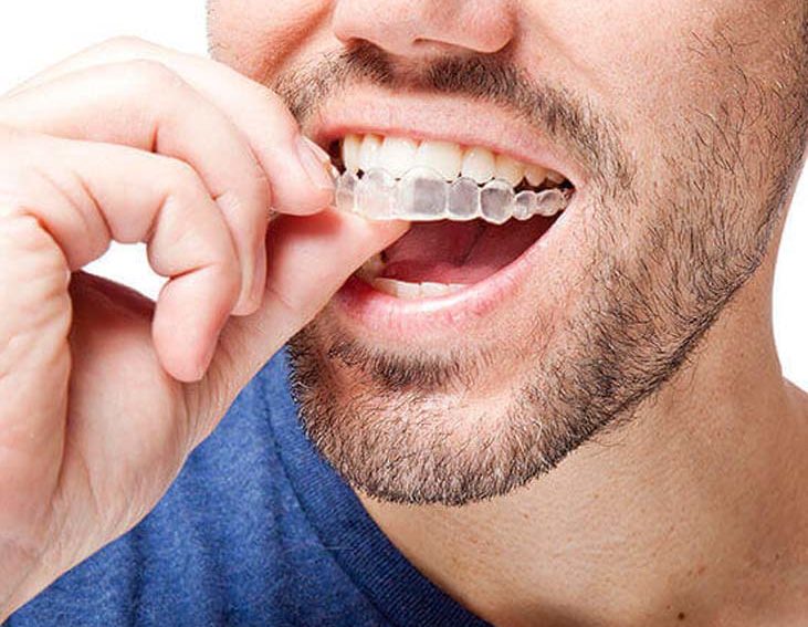 Comment Aligner Ses Dents
