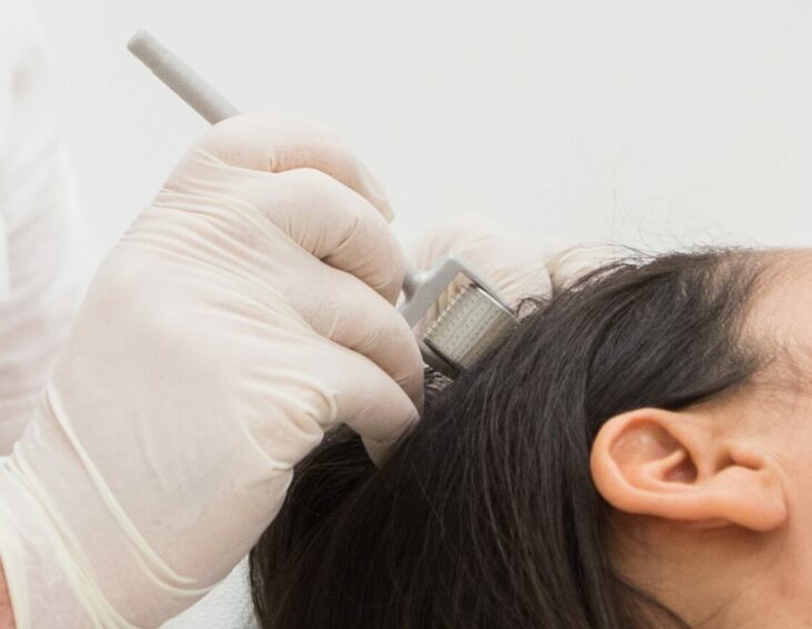 microneedling cheveux